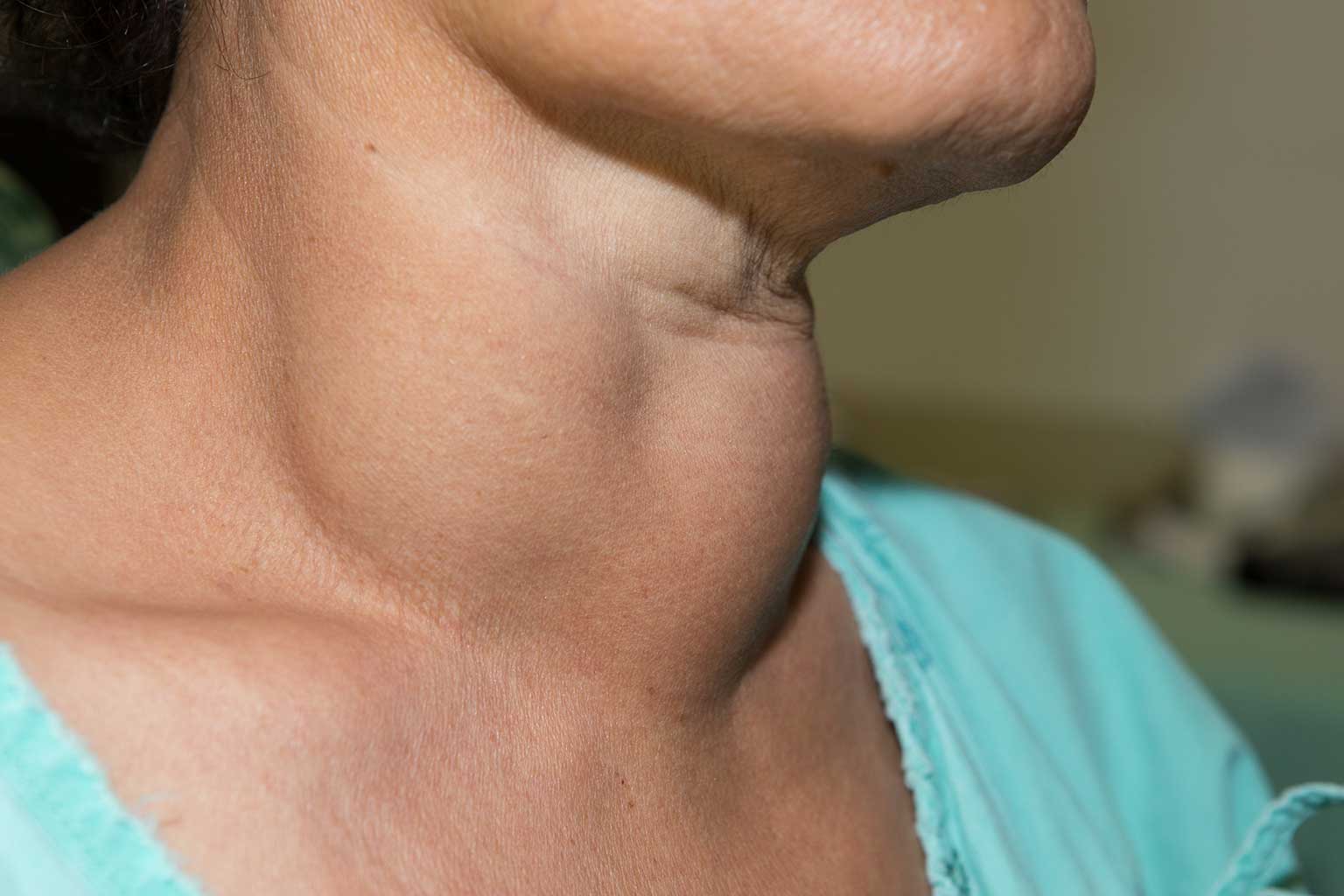 Thyroid: Women Should Take Care Of Them